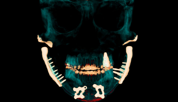 A scan of a person's skull with jaw impants highlighted.